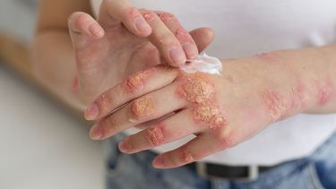 Día Mundial de la Psoriasis: cuál es el origen y el significado del 29 de octubre Día Mundial de la Psoriasis: cuál es el origen y el significado del 29 de octubre