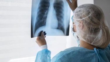 Las claves detrás de la histórica baja de casos de tuberculosis en Mendoza.