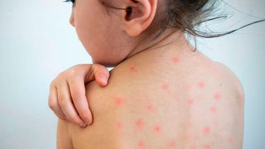 Salud adelantó la dosis de sarampión para frenar los brotes: cuándo hay que aplicarla. Salud adelantó la dosis de sarampión para frenar los brotes: cuándo hay que aplicarla.