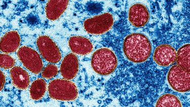 viruela del mono: estados unidos detecto mas casos y la oms subio el nivel de alerta en el mundo