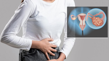 El cáncer de ovario representa la cuarta causa de muerte por esta enfermedad.