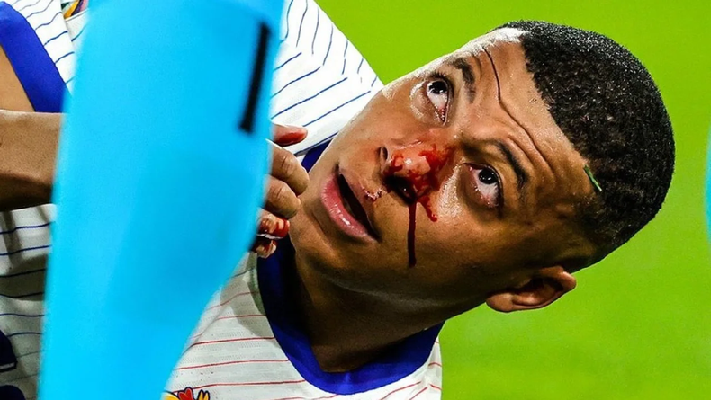 Eurocopa: Kylian Mbappé se lesionó y será operado.