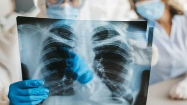 La tuberculosis sigue siendo una de las enfermedades infecciosas más mortales del mundo.
