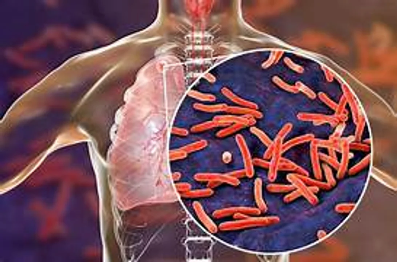 Aumentaron un 38% los casos de tuberculosis en la República Argentina