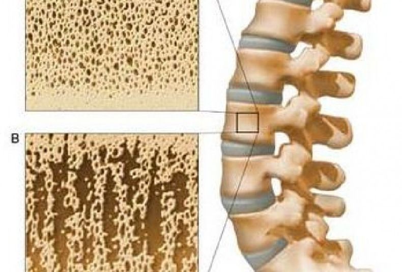 Osteosporosis