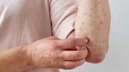 Ante la amenaza de sarampión en Argentina, declaran la alerta epidemiológica en Chile