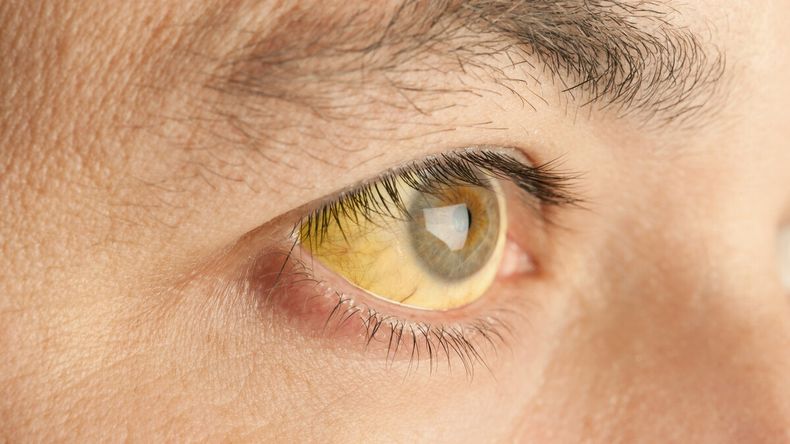 Uno de los principales mitos que siguen vigentes es pensar que una persona que tiene hepatitis va a presentar un color amarillo en la piel, precisa la Dra. Sofía Tejada Rico.
